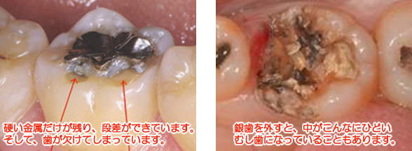 銀歯の段差とむし歯