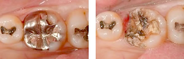 金属（特にパラジウムと呼ばれる銀歯）を外すと、その下が虫歯になっていることがとても多い